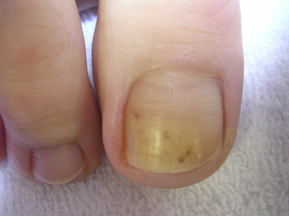 Anti-Fungal Toe Tincture Spray